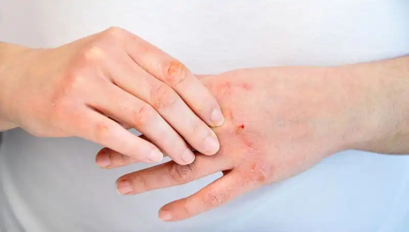 Yetersiz Protein Tüketiminin Belirtileri: 6 Uyarı İşareti